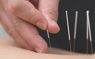 Acupuncture