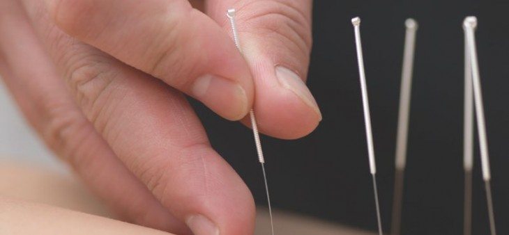 Acupuncture