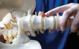 disc bulge treatment rouse hill