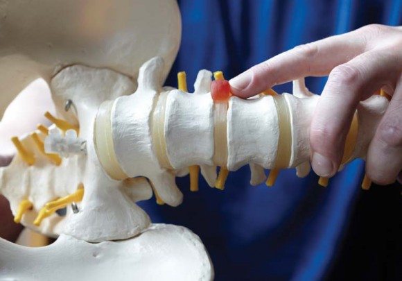 disc bulge treatment rouse hill